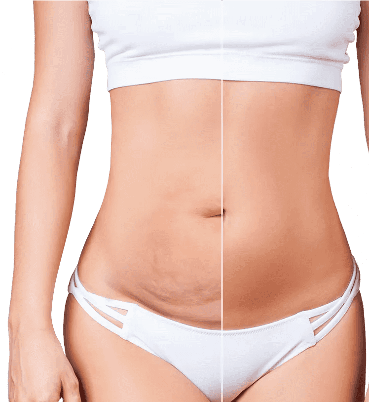 How To Get A Tummy Tuck For Free Canada