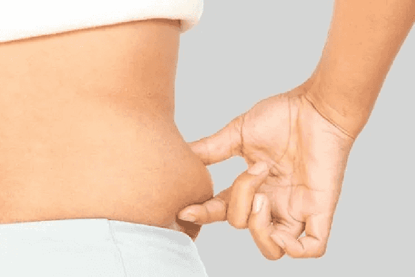 Liposuction